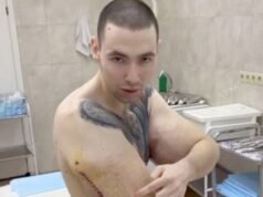 Waktu hampir habis bagi ‘Popeye Rusia’ yang menyuntikkan minyak ke otot bisepnya saat ia ‘menghadapi amputasi’